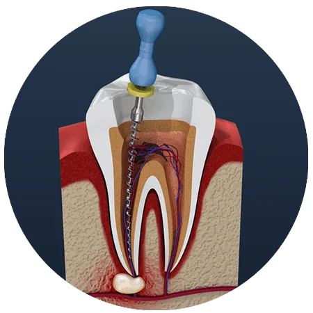 Rootcanal-treatment